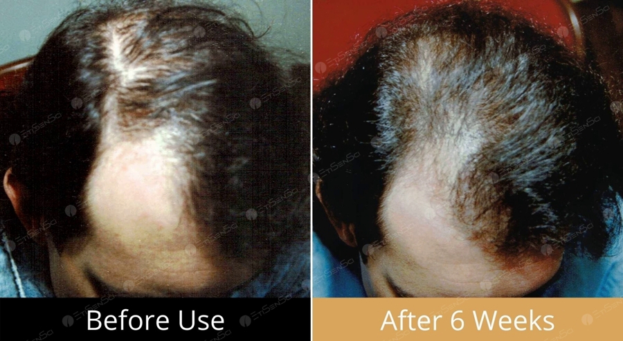 Testimonial 14 hair loss reversal of male with Oxtiditronomidex Syndrome by hair loss solution Hair Loss Combatant