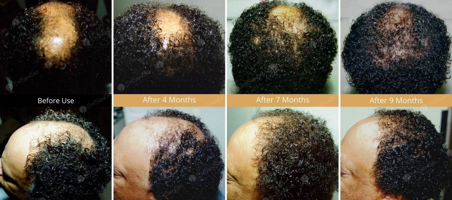 User journey 2 hair loss reversal of male with Oxtiditronomidex Syndrome by hair loss solution Hair Loss Combatant