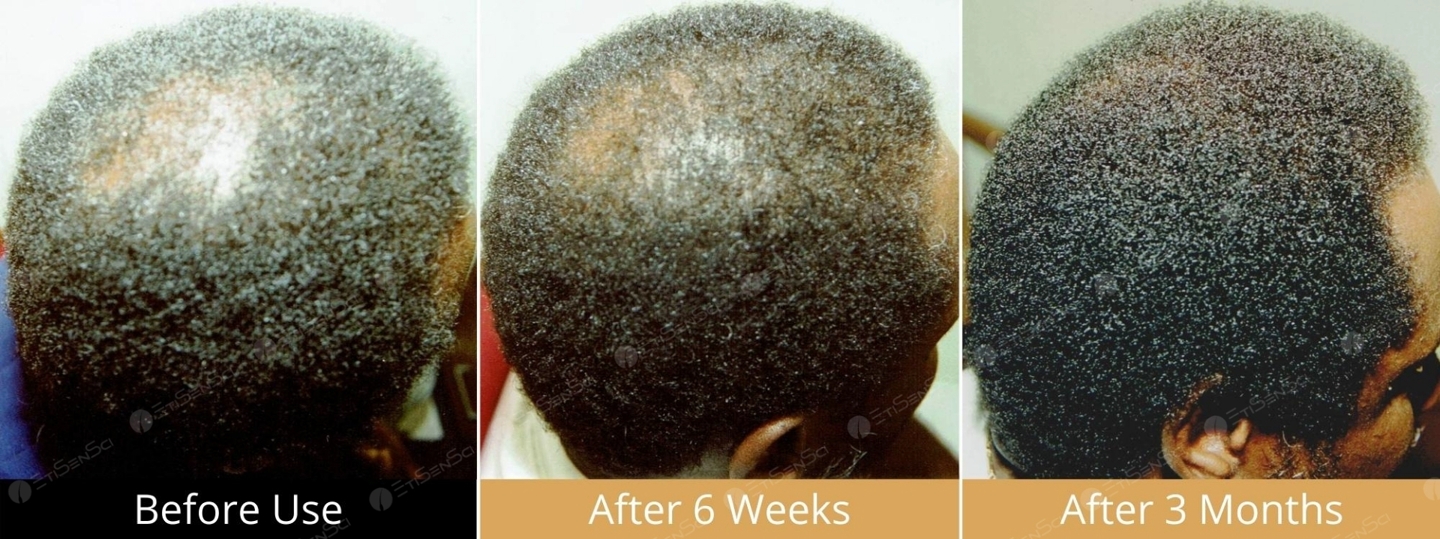 User journey 8 hair loss reversal of male with Oxtiditronomidex Syndrome by hair loss solution Hair Loss Combatant